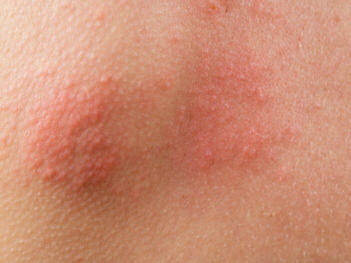 Shingles